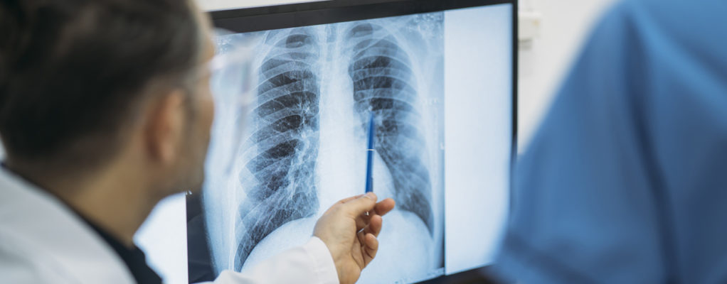 Doctor pointing at lung xray