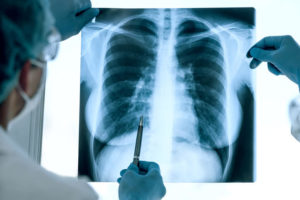 A doctor examines a chest X-ray image and points to an area on the right lung. 